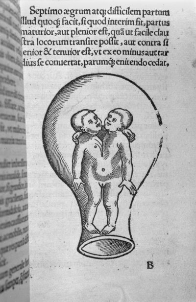 Niños siameses, ilustración del llamado manuscrito Rhodion de French School