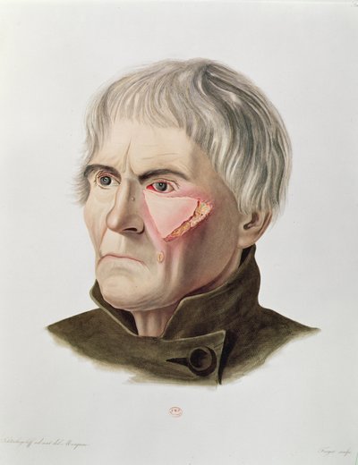 Operación de injerto de piel, de Selecta Praxis Medico-Chirurgica por Alexander Auvert, París, 1856 de French School