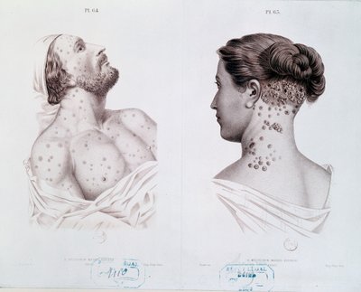Síntomas de sífilis en hombres y mujeres, de un libro médico, c.1850-60 de French School