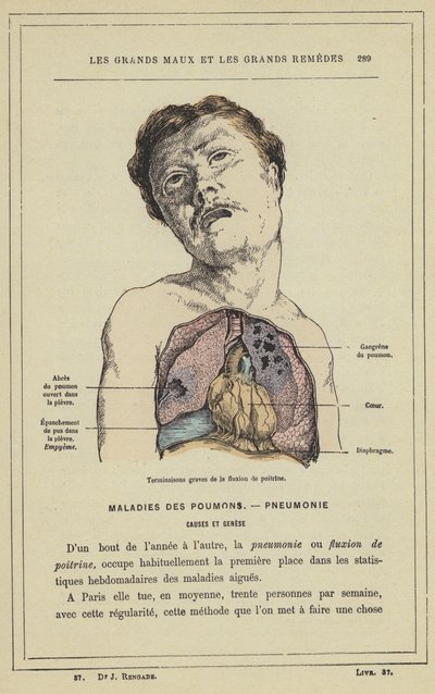 Terminaciones graves de la congestión pulmonar de French School