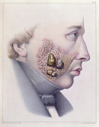 Los síntomas faciales de la enfermedad venérea, de Traite Complet des Maladies Veneriennes por Philippe Ricord (1800-89) 1851 de French School