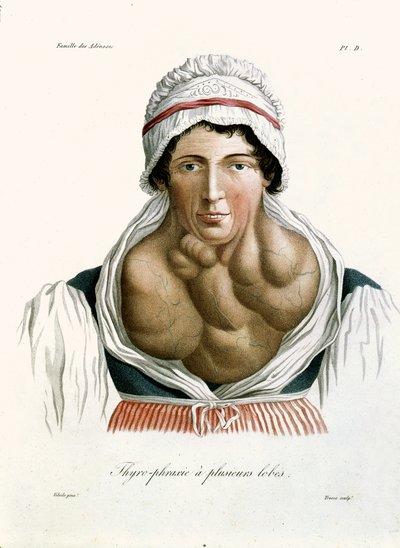 Enfermedad tiroidea, de un libro de Baron Jean Louis Alibert, 1817 de French School