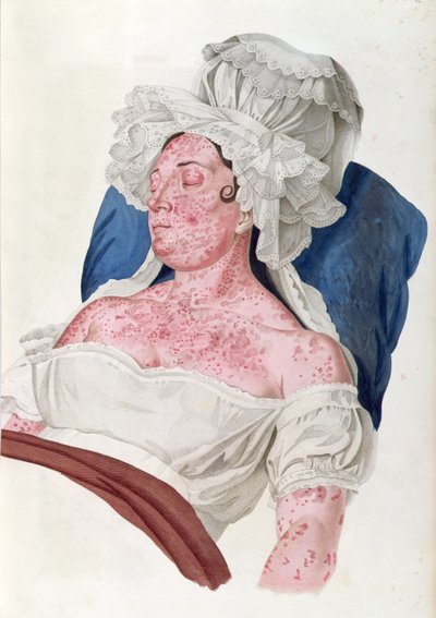 Mujer con fiebre escarlata, de un libro de Baron Jean Louis Alibert, grabado por Choupard, 1833 de French School