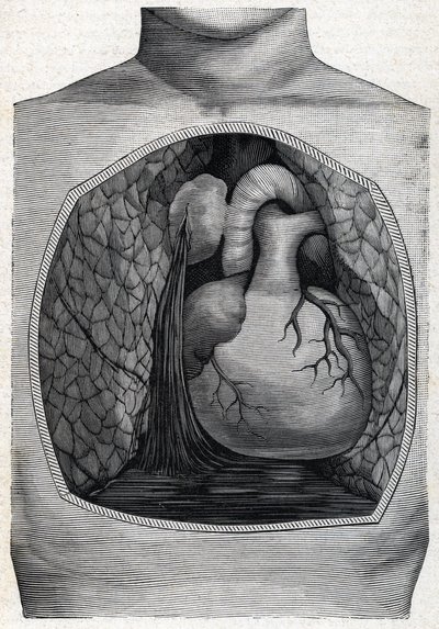 Ruptura de aneurisma, 1888 de French School