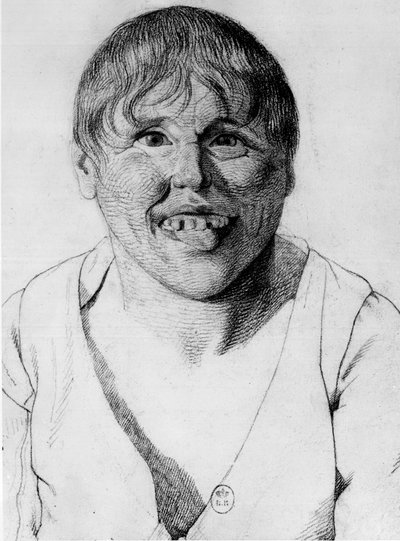 Cretino, -en “Etude de la physionomie des aliénés”, dibujo de Gabriel de Georges Francois Gabriel