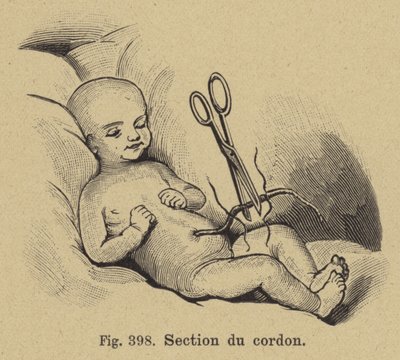 Corte del cordón umbilical de un recién nacido de German School