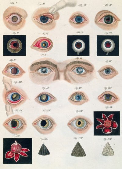 Descripción de anomalías congénitas del ojo, de Klinische Darstellungen der Krankheiten und Blidungsfehler des Menschlichen Auges, por Friedrich August von Ammon (1799-1861) 1838 de German School