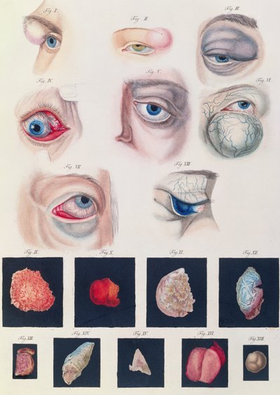 Descripción de anomalías congénitas del ojo, de Klinische Darstellungen der Krankheiten und Blidungsfehler des Menschlichen Auges, por Friedrich August von Ammon (1799-1861) 1838 de German School