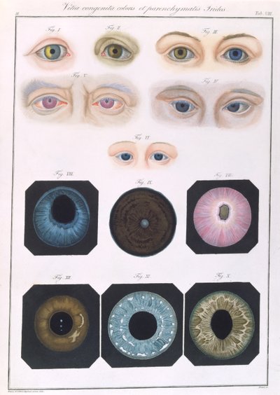 Descripción de anomalías congénitas del ojo, de Klinische Darstellungen der Krankheiten und Blidungsfehler des Menschlichen Auges, por Friedrich August von Ammon (1799-1861) 1838 de German School
