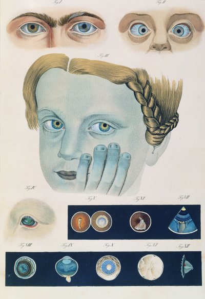 Descripción de anomalías congénitas del ojo, de Klinische Darstellungen der Krankheiten und Blidungsfehler des Menschlichen Auges, por Friedrich August von Ammon (1799-1861) 1838 de German School