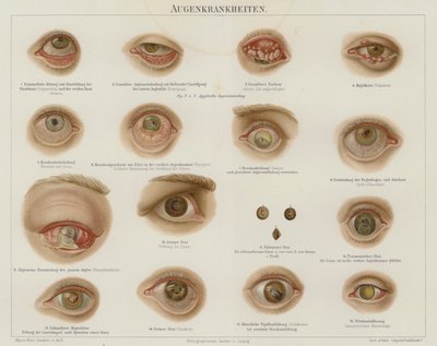 Trastornos oculares de German School