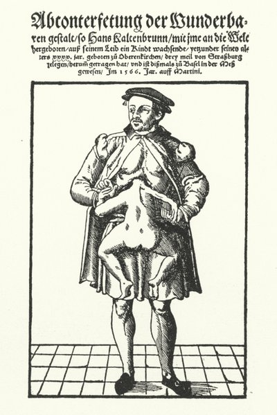 Hans Kaltenbrunn y su gemelo unido no desarrollado de German School
