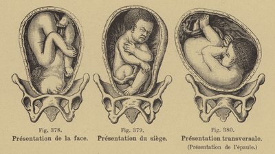 Malpresentación de bebés en el útero antes del nacimiento de German School