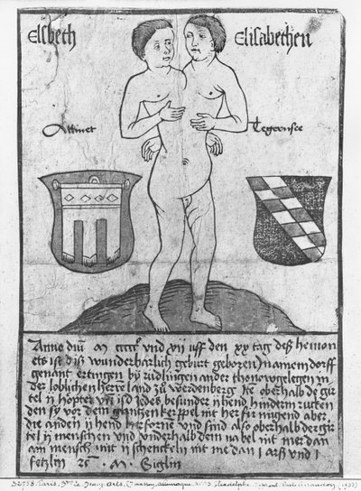 Chicas siamesas, Elsbeth y Elisabethen (xilografía y acuarela) de German School