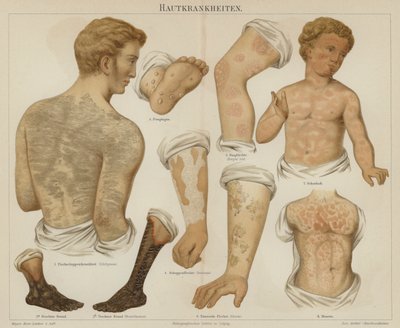 Trastornos de la piel (litografía en color) de German School