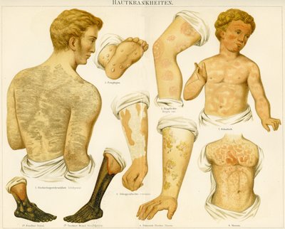 Trastornos de la piel, c.1890 de German School