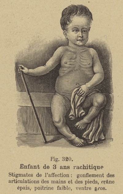 Niño de tres años con raquitismo de German School