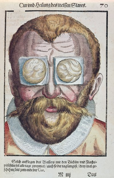 Tratamiento de una afección ocular, de Ophthalmodouleia por Georg Bartisch (1535-1636) publicado en Dresde en 1583 de German School