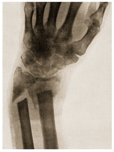 Radiografía de una muñeca fracturada c.1890 de German School