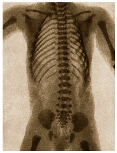 Radiografía de un torso humano c.1890 de German School