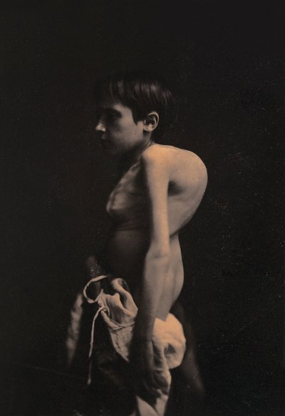 Retrato de un niño jorobado, c.1855-57 de Guillaume Benjamin Armand Duchenne de Boulogne