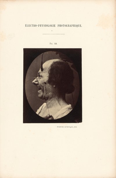 Electrofisiología fotográfica, Figura 39 de Guillaume Benjamin Duchenne