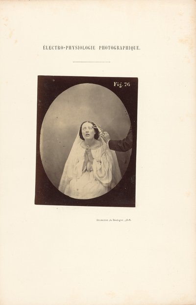 Electrofisiología fotográfica, Figura 76 de Guillaume Benjamin Duchenne