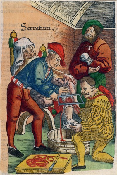 Una Amputación, ilustración de 
