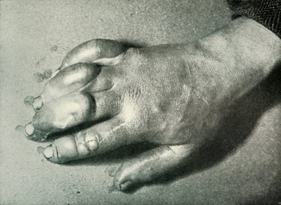 La Mano Congelada del Dr. Atkinson, 5 de julio de 1911, 1913 de Herbert Ponting