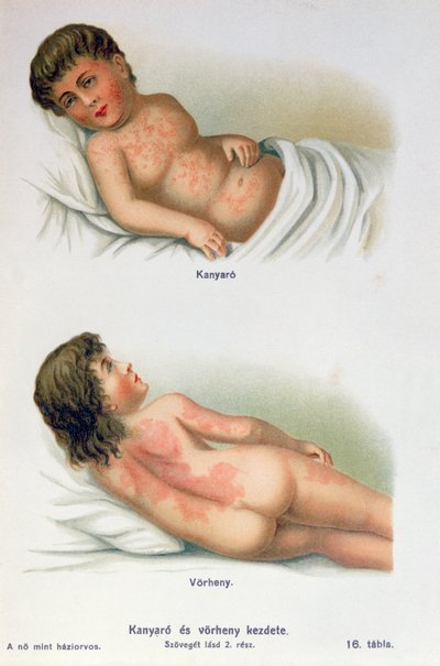 Sarampión y escarlatina, de un libro médico familiar, c.1900 de Hungarian School