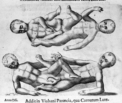 Diferentes tipos de monstruos humanos: niños siameses conectados por la pelvis. Grabado de “De monstrorum natura, causis et differentiis” de Fortunio Liceti (1577-1656), científico italiano. 1646 de Italian School