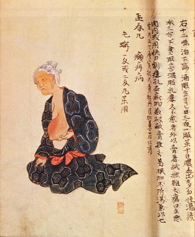 El primer tratamiento quirúrgico del cáncer de mama realizado bajo anestesia general por Seishu Hanaoka (1760-1836) en 1804 de Japanese School