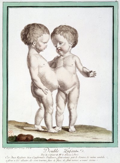 Niños siameses - en “Las desviaciones de la naturaleza” por Régnault de Jean Baptiste Regnault