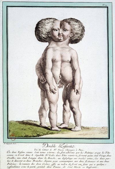 Niños siameses - en “Las desviaciones de la naturaleza” por Régnault de Jean Baptiste Regnault