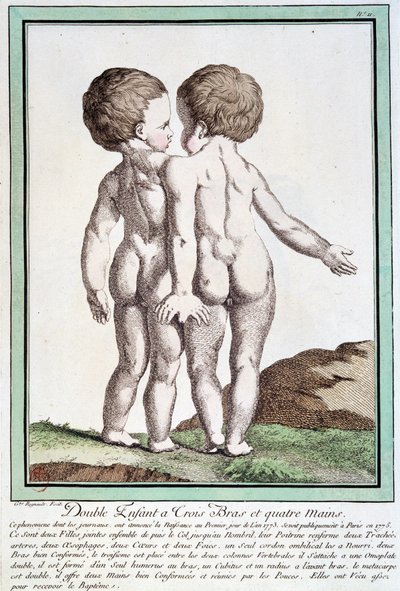 Niños siameses - en "Las desviaciones de la naturaleza" de Régnault de Jean Baptiste Regnault