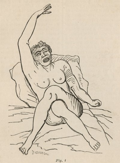 Epilepsia histérica, ataque, contorsiones, fig. 1 de 
