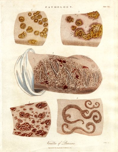 Cambios patológicos de la piel: Variedades de psoriasis de John Pass
