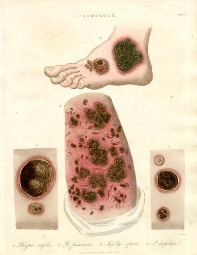 Afecciones cutáneas patológicas - Pitiriasis;Impétigo y Sífilis de John Pass