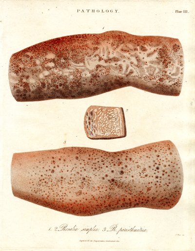 Erupciones cutáneas - Roseola simplex y Roseola paristhmitica de John Pass