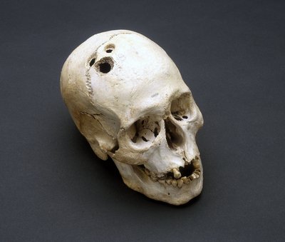 Trepanación de un cráneo de la Edad de Bronce, Jericó, Palestina, 2200-2000 a.C. de Unbekannt Unbekannt
