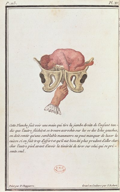 Diagrama transversal de un bebé sacado del útero por el brazo, de un libro de Madame Angélique Le Boursier du Coudray grabado por J. Robert, 1783 de P. Chapparre