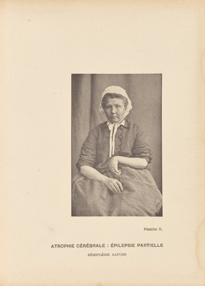 Atrofia cerebral: Epilepsia parcial Hemiplejia izquierda de Paul Marie Léon Regnard