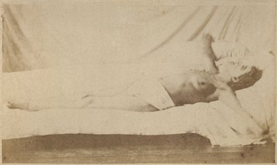 Epilepsia histérica, ataque, crucifixión, lámina VI de 