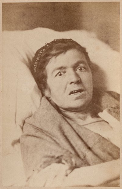 Epilepsia histérica, contracción facial, lámina VIII de 