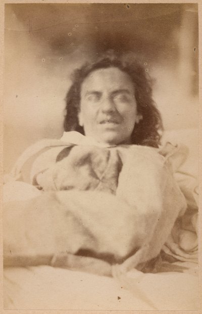 Epilepsia histérica, alucinaciones, ironía, lámina XXXII de 