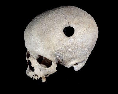 Cráneo prehistórico con traza de trepanación, Museo de Antigüedades Nacionales de Prehistoric Prehistoric