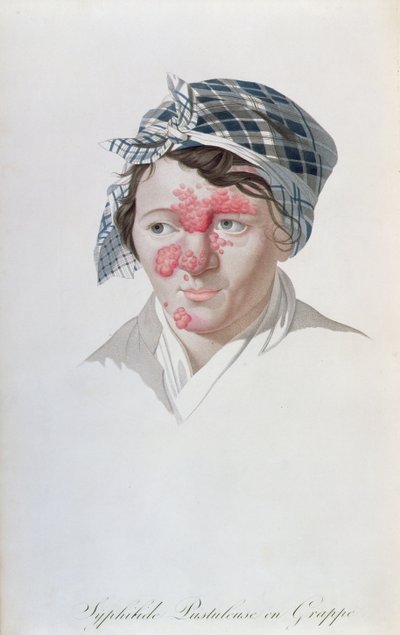 Pústulas sifilíticas agrupadas, de un libro de Baron Jean Louis Alibert, 1838 de Salvadore Tresca