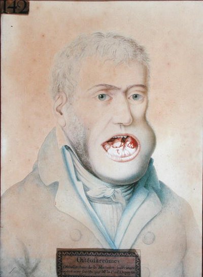 Osteosarcoma de la mandíbula inferior, operado con éxito por Guillaume Dupuytren (1777-1835) de School French