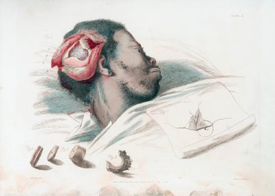 Vista de herida en el cráneo después de trepanación y extracción de fragmento de hueso roto en la parte inferior izquierda, 1821 de Thomas Landseer
