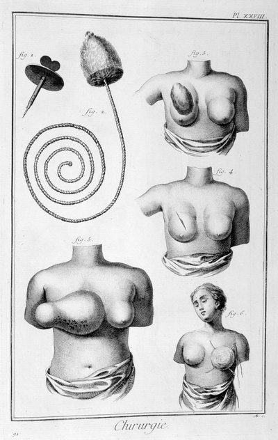 Cirugía de mama, 1751-1777 de Unbekannt
